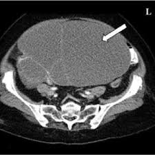 A ct scan takes pictures of the inside of the body. Pdf Characterization Of Adnexal Masses Using Multidetector Contrast Enhanced Ct Scan Recognising Common Pitfalls That Masquerade As Ovarian Cancer