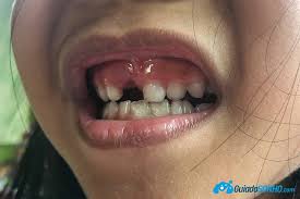 Sonhar Com Dente Veja Revelacoes Inacreditaveis Click Sonhando arrancar dentes é um pouco diferente do significado comum desse sonho, em que direção vê seus dentes serem arrancados? sonhar com dente veja revelacoes
