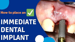 Image result for dental implant