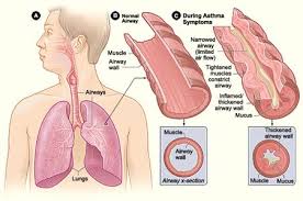 Here are the six most important questions you need to know about severe asthma. Asthma Physiopedia