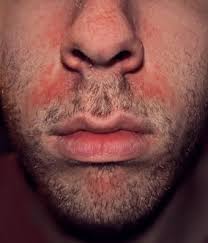 Pg Intolerance Recognising The Symptoms And What You Can Do About It