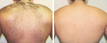 We are an experienced laser hair removal clinic in london, specialising in providing the best laser hair removal treatments available for the best prices. Laser Hair Removal London London Premier Laser Clinic