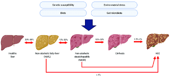 Liver function plays a serious role in digestion. The Natural History Of Non Alcoholic Fatty Liver Disease Nafld And Download Scientific Diagram