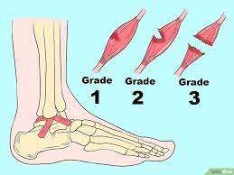 4 Ways To Treat A Sprained Ankle Sprained Ankle Sprain Treating A Sprained Ankle