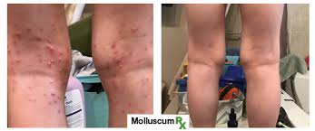 Until the molluscum bumps go away, molluscum is contagious. Molluscumrx Pain Free Natural Molluscum Contagiosum Treatment