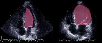 This form of stress testing is usually performed with exercise protocols using either a treadmill or bicycle. 3 2 The Left Ventricle 123 Sonography