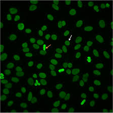 Image result for ANA Staining Pattern