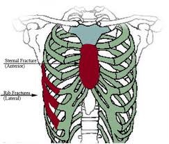 Image result for Flail Chest