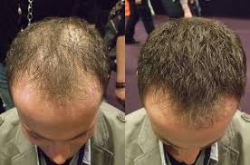 In diesem video stelle ich euch meine vorher nachher ergebnisse nach der op vor. Geheimratsecken Kaschieren Unsere Top 6 Methoden Super Million Hair