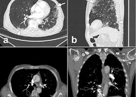 Pour ce faire, le patient se verra poser une voie intraveineuse. Decouverte Mondiale Contre Le Covid 19 Au Chu De Besancon Un Angioscanner Pulmonaire Plutot Qu Un Scanner Sans Injection Algerie 1