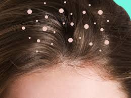 By a show of hands, who used glovers mane (now called glovers dandruff treatment) as a growth aid as a child? What Causes Dandruff The Truth Behind 9 Common Dandruff Myths Self