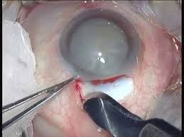 Image result for Cataract Extraction