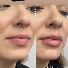 TOP 10 BEST Stretch Mark Removal in Stockton, CA