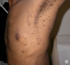 Image result for Diffuse Hyperpigmentation