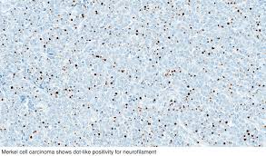 Merkel cell carcinoma was previously believed to arise from merkel cells , which are pressure receptors in the skin. Pathology Outlines Merkel Cell Carcinoma