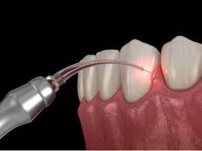 Laser Root Canal Treatment product image