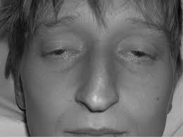 This weakness may spread to the neck, arms, torso, and legs. Botulism A Rare Complication Of Injecting Drug Use Emergency Medicine Journal