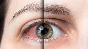 kolobom nedir kolobom nedenleri belirtileri ve tedavisi saglik son dakika haberler