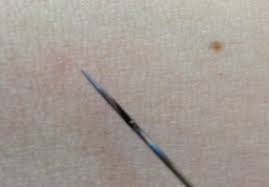 Some blood tests (such as liver enzymes, alt and ast concentration an ast/alt ratio) could show if there is one. Dallas Mom Blog And Fort Worth Mom Blogger Trendy Mom Reviews How I Removed Cherry Angiomas At Home