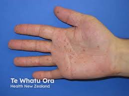 Image result for dyshidrosis