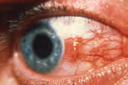 Image result for Ciliary Flush