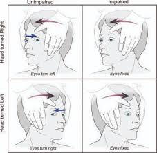 Image result for Oculovestibular Testing