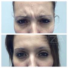 El tratamiento de botox se asocia frecuentemente con lifting facial, implantes de ácido hialurónico y el ácido hialurónico es un componente esencial de nuestra piel, que sirve como soporte del colágeno y por ejemplo extrae grasa del estómago y la inyectan en la cara para darle más volumen. Precio De Botox Cual Es El Precio 130 Zona Facial