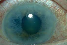 If you have the condition, you'll. Glaucoma Treatment Symptoms Causes 6 Tests Surgery