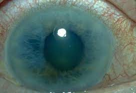 Consult a doctor for medical advice. Glaucoma Treatment Symptoms Causes 6 Tests Surgery
