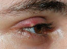 Stye - Wikipedia
