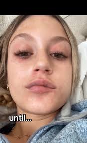 Beginning Stages of Psoriasis