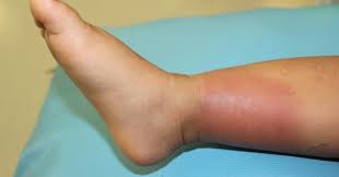 Sepsis is a serious medical condition caused by the body's response to an infection. Was Ist Eine Blutvergiftung Gesundheit Medikamente