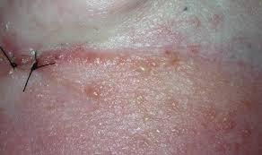 Inflammatory breast cancer (ibc) symptoms may include: Image Gallery Ibc Network Australia