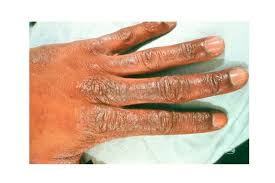 Tory submerged himself in a cold water tank and managed to stay in the tank for an hour. What S That Rash How To Id Common Rash Symptoms The Healthy
