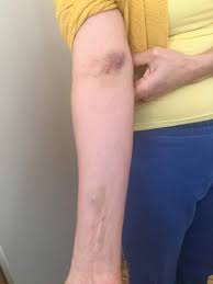 Außerdem sollte man dem arm an dem tag ruhe gönnen. Blaue Flecken Nach Schmerzhafter Blutabnahme Gesundheit Und Medizin Gesundheit