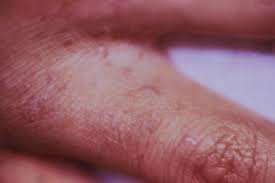 Através do sarcoptes scabiei var. Infestacao Por Sarna Disturbios Da Pele Manual Msd Versao Saude Para A Familia