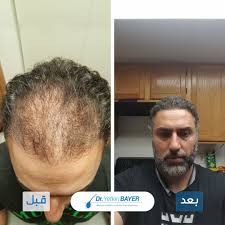 قبل وبعد زراعة الشعر