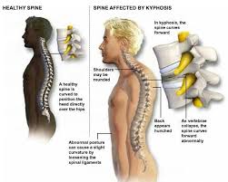 Kyphosis
