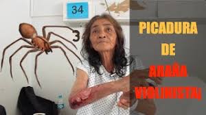 La mordedura de la araña violinista tiene una característica muy común: Sra Violeta Chinas Paciente Con Picadura De Arana Violinista En Cuautla Morelos Youtube