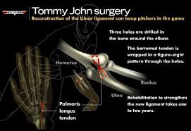 He's since been hospitalized on two other occasions, including a third time. What Pitchers Need To Know About Tommy John Surgery
