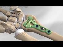 Distal Radius Fracture Repair - Volar Plate