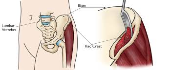 Answers (1) like the answers? Cervical Radiculopathy Surgical Treatment Options Orthoinfo Aaos