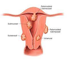 Fibroids are benign tumours of the uterus (womb). What Is A Myoma Causes Types Symptoms And Treatments