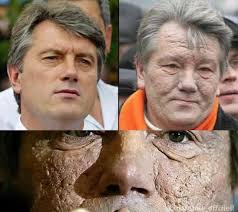 In 2004, Ukrainian presidential candidate Viktor Yushchenko was poisoned  with an extremely high dose of dioxin (TCDD) during the election campaign