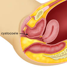Pərnah dengar rahim jatuh @ teturun? Bab 10 Prolaps Uteri Melaka Fertility Selva S Fertility Obstetrics And Gynaecology Clinic