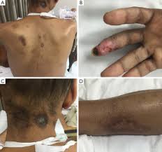 Image result for Neurotic Excoriation