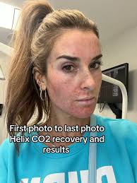 How Long Does It Take to Cover from Co2 Laser