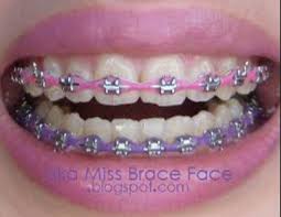 Cute Multicolored Braces Cute Braces Colors Braces Colors Braces Teeth Colors