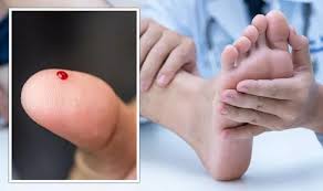Image result for brown patches on the feet