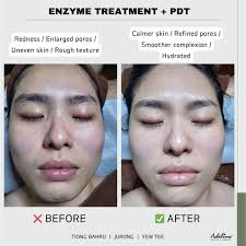 Tired of redness, rough skin and enlarged pores?" This customer tried our  Enzyme Treatment + PDT Light Therapy— And here's the result: ✔️ Calmer,  soothed skin ✔️ Less redness & sensitivity ✔️